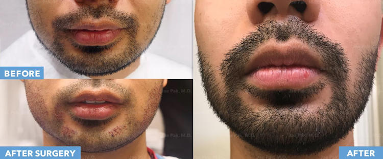 beard grooming